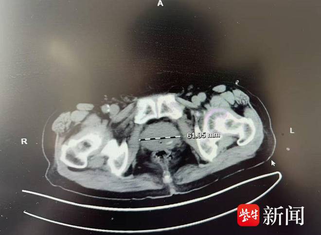 高龄不是“禁区”！句容人医泌尿外科助力93岁老人告别“男”言之隐(图2)